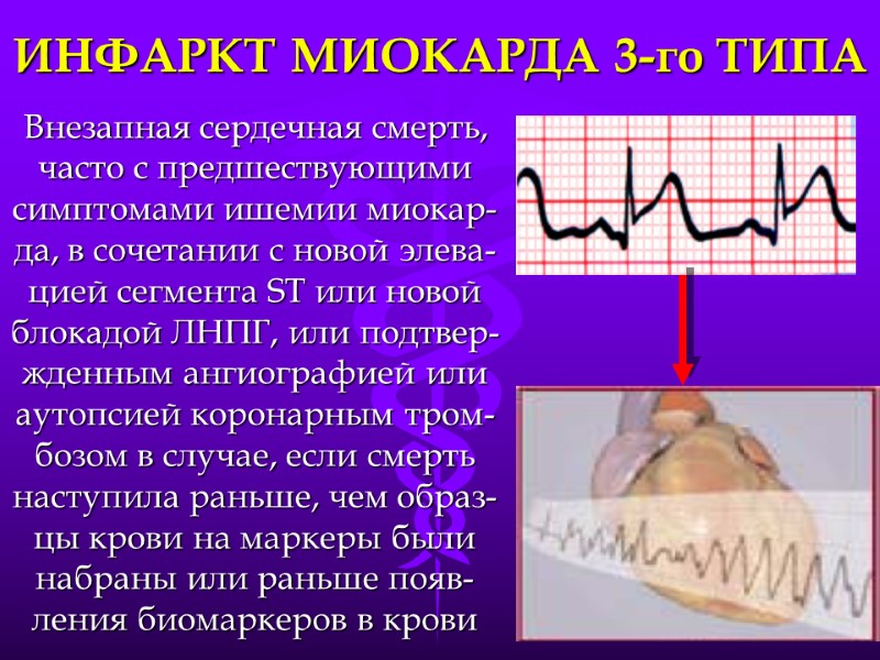 ИНФАРКТ МИОКАРДА 3-го ТИПА Внезапная сердечная смерть, часто с предшествующими симптомами ишемии миокар-да, в